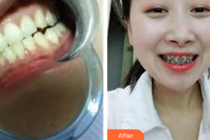 深圳博愛曙光醫(yī)院劉佺整形價格表附牙齒矯正案例展示