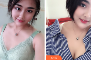 珠海陸達美容外科醫(yī)院陳越文整形價格表附自體脂肪隆胸案例展示