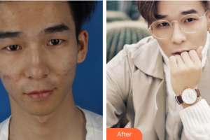 珠海陸達美容外科醫(yī)院曾超整形價格表附微針祛痘煥膚案例展示