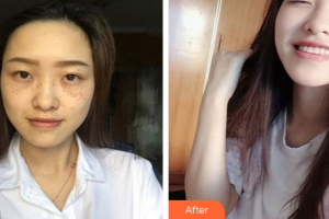 珠海陸達美容外科醫(yī)院王愛平整形價格表附激光美膚祛斑案例展示