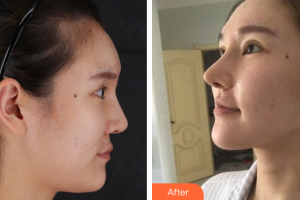 珠海陸達美容外科醫(yī)院劉仁和整形價格表附肋骨隆鼻案例展示