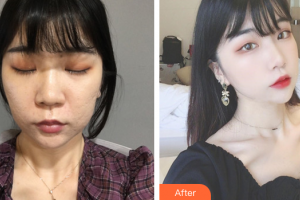 珠海陽光醫(yī)院整形美容中心鄧宇茜整形價格表附去痘印痘坑案例展示