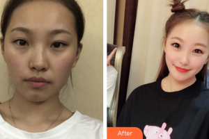 珠海六和醫(yī)院醫(yī)學美容科周玲玲整形價格表附光子嫩膚案例展示