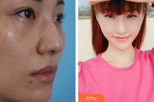 珠海方華醫(yī)院醫(yī)學美容科方明整形價格表附激光祛斑案例展示