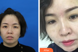 珠?；輴坩t(yī)院整形美容科陳曉華整形價格表附微針美膚案例展示