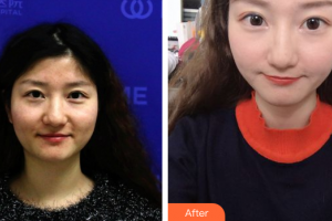 珠?；輴坩t(yī)院整形美容科董仲琴整形價格表附微針美膚案例展示