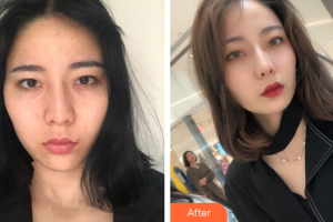 珠海陽光醫(yī)院整形美容中心周輝整形價格表附超激光美膚美白祛斑案例展示