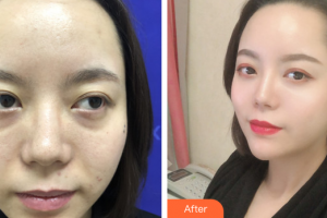 珠?？泼泪t(yī)療美容醫(yī)院李金瓊整形價格表附私人訂制童顏術(shù)基礎(chǔ)版案例展示