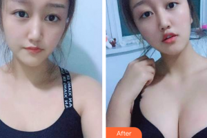 珠海科美醫(yī)療美容醫(yī)院張民望整形價格表附自體脂肪隆胸案例展示