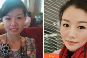 珠海海大整形美容外科葉英梅整形價格表附點陣激光案例展示