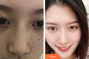 珠海萊茵醫(yī)療美容醫(yī)院崔俊溶整形價格表附祛斑祛痣案例展示