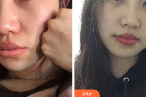 珠海萊茵醫(yī)療美容醫(yī)院權(quán)競元整形價格表附光子嫩膚案例展示