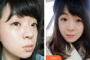 珠海萊茵醫(yī)療美容醫(yī)院周亞莉整形價格表附超激光美膚案例展示