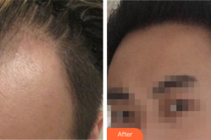 珠海萊茵醫(yī)療美容醫(yī)院李尚旭整形價格表附種植發(fā)際線案例展示