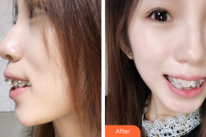 珠海陸達美容外科醫(yī)院程琦整形價格表附自鎖托槽矯正案例展示