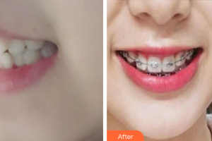 珠海陸達美容外科醫(yī)院曹宇整形價格表附自鎖矯正案例展示