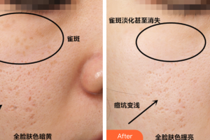 珠海陸達美容外科醫(yī)院黃志紅整形價格表附激光祛斑案例展示