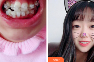 珠海陸達美容外科醫(yī)院何維森整形價格表附陶瓷矯正案例展示