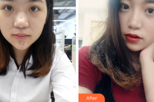 珠海九龍醫(yī)院醫(yī)學美容科鐘小榮整形價格表附清潔祛痘案例展示