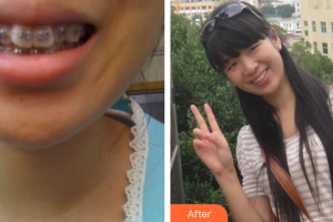 珠海九龍醫(yī)院醫(yī)學美容科趙璽恩澤整形價格表附金屬矯正案例展示