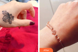 珠海微創(chuàng)外科醫(yī)院姜東求整形價格表附超激光美膚洗紋身案例展示