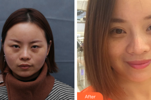 珠海吉大郭閆伏醫(yī)療美容診所林德金整形價格表附眼部整形案例展示