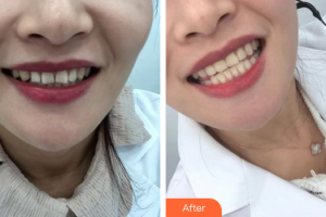 珠海愛思特醫(yī)療美容醫(yī)院韓繼新整形價格表附口腔美白貼面案例展示