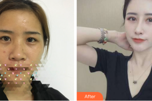 珠海藝星（原仁愛）醫(yī)療美容門診部趙世平整形價格表附眼鼻部手術(shù)案例展示