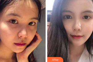 珠海藝星（原仁愛）醫(yī)療美容門診部郭長元整形價格表附熱瑪吉案例展示