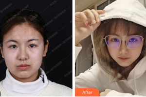 珠海微創(chuàng)外科醫(yī)院金涥澤整形價格表附切開雙眼皮案例展示