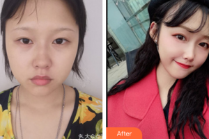 珠海陽光醫(yī)院整形美容中心謝秋萍整形價格表附埋線提升案例展示