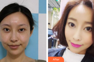 珠海美涵醫(yī)療美容門診部邵偉整形價格表附埋線提升案例展示