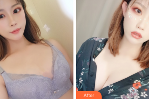 珠海美涵醫(yī)療美容門診部李春雷整形價格表附自體脂肪隆胸案例展示