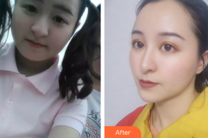 珠海市第二人民醫(yī)院整形美容科黃綺梨整形價格表附面部吸脂案例展示