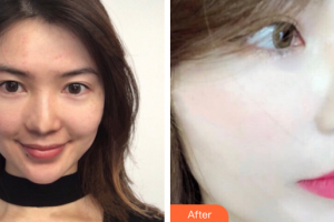 珠海市第二人民醫(yī)院整形美容科夏瓊平整形價格表附光子嫩膚案例展示