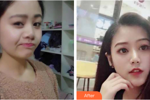 珠海艾瑞醫(yī)療美容醫(yī)院熊學俊整形價格表附自然小翹鼻案例展示