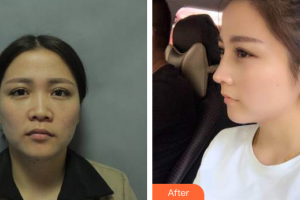 珠海艾瑞醫(yī)療美容醫(yī)院祝小偉整形價格表附鼻部手術(shù)案例展示