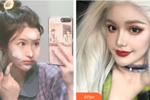 珠海陽光醫(yī)院整形美容中心高廣華整形價格表附膨體肋軟骨隆鼻案例展示