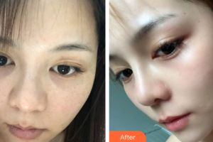 珠海韓妃醫(yī)療美容門診部曾桂芳整形價格表附蜂巢激光美膚案例展示