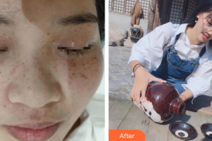 珠海陳科醫(yī)療美容診所覃壽安整形價格表附激光祛斑案例展示