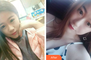 珠海吉大郭閆伏醫(yī)療美容診所郭秉霖整形價格表附白瓷娃娃案例展示