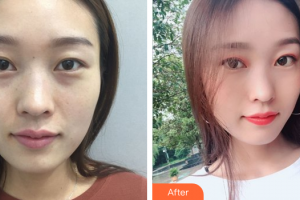 珠海韓妃醫(yī)療美容門診部項(xiàng)曉飛整形價格表附鼻部手術(shù)案例展示