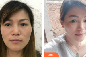 珠海蒂伊醫(yī)療美容門診部石巍巍整形價格表附激光祛斑案例展示