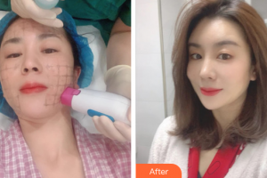 珠海蒂伊醫(yī)療美容門診部廖俊凱整形價格表附熱瑪吉案例展示