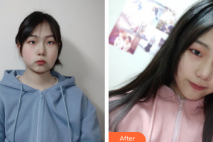 珠海愛思特醫(yī)療美容醫(yī)院周潔松整形價格表附埋線提升案例展示