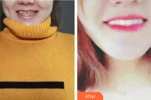 珠海拜博口腔醫(yī)院閻璐整形價(jià)格表附瓷貼面案例展示