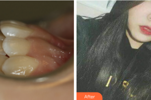 珠海拜博口腔醫(yī)院彭德浩整形價(jià)格表附隱適美矯正案例展示