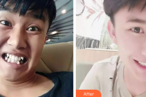 珠海拜博口腔醫(yī)院譚澤深整形價(jià)格表附金屬矯正案例展示