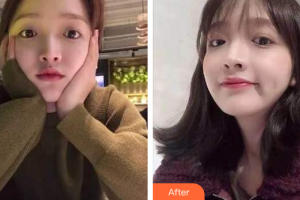 珠海拜博口腔醫(yī)院徐承磊整形價(jià)格表附超聲波潔牙案例展示