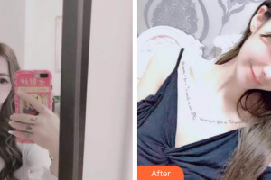 珠海拜博口腔醫(yī)院程旭整形價(jià)格表附時(shí)代天使矯正案例展示